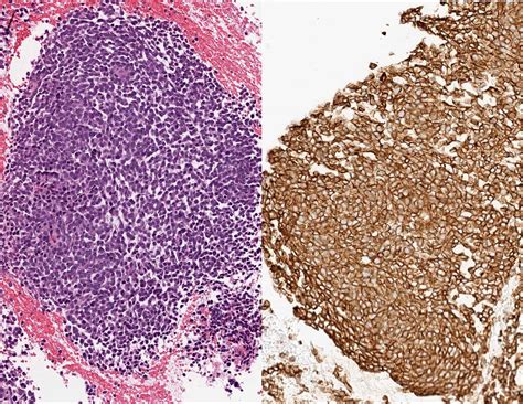 cd99 pathology outlines